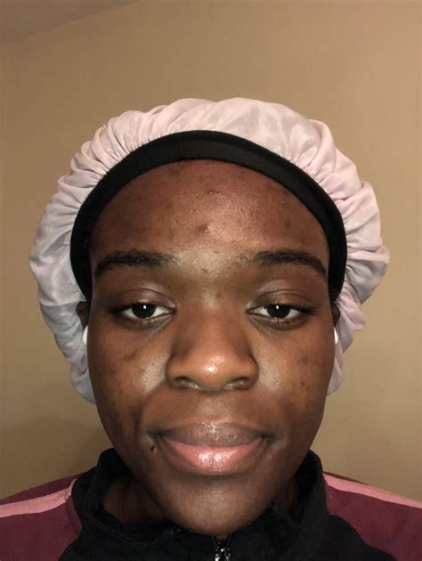 how to get accutane 1