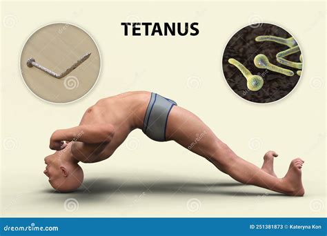 Pessoa Com Tétano Avançado - Oisthotonus Num Homem Que Sofre De Tétano Ilustração Stock - Ilustração ...