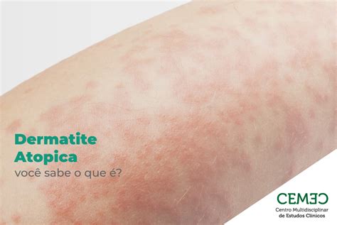 Dermatite Atópica É Doença Autoimune - dermatite-atopica | CEMEC