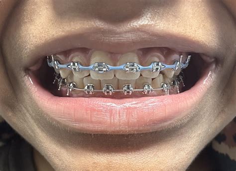 Do my teeth look okay? : r/braces