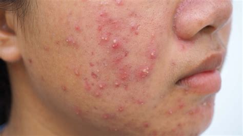 cystic acne explained  symptoms  treatments