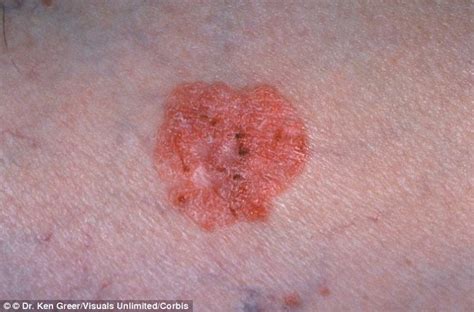 black itchy spot  skin pictures