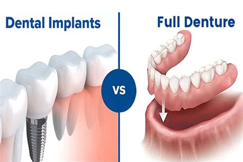 Dentures vs. Implants: A Detailed and Complete Guide