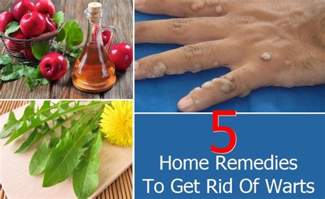 Top 5 Home Remedies To Get Rid Of Warts | Find Home Remedy & Supplements