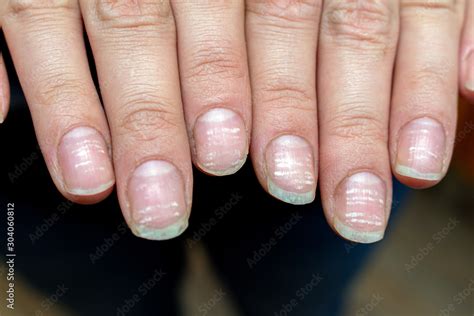 vitamin deficiency avitaminosis anemia nail problem with white dots ...
