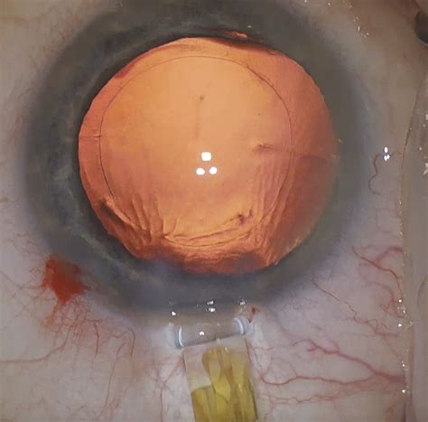 Cataract surgery steps