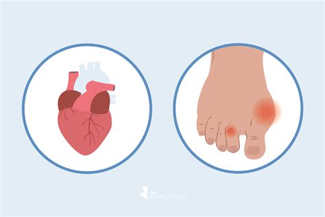 Gout and Heart Disease: Why You’re at Increased Risk