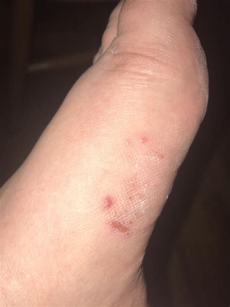 Itchy Bump On Foot at Ana Means blog