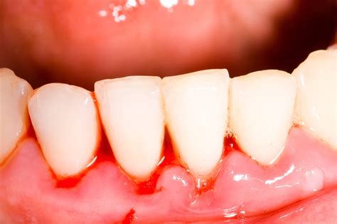 Why Are My Gums Bleeding? - Avenue Dental Arts