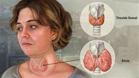 Remédio Para Diminuir O Bócio - Os 10 Remédios Caseiros Para Tratar Bócio Naturalmente | Dicas de Saúde