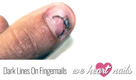 Vertical Lines on Fingernails | How To Achieve Healthy Nails