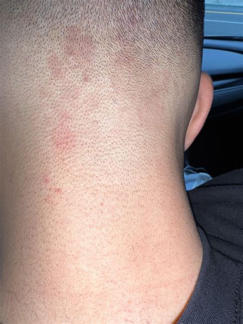 Scabies on scalp ? : r/scabies