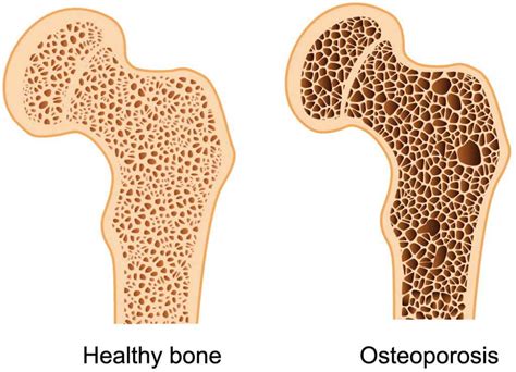 What is Osteoporosis? - Haven Pharmacy