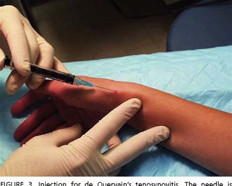 Digital flexor tenosynovitis | Semantic Scholar