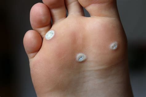 young plantar warts