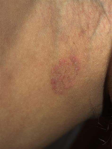 It’s bumps or herpes : r/sexadvise