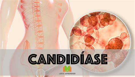 Quais Sao Os Sintomas De Candidíase - O que é candidíase - Sintomas, tratamento, candidíase recorrente