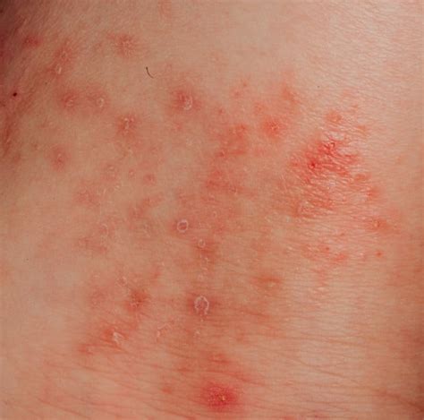 O Que É Eczema Pulmonar - O Que É Eczema Pulmonar? _ Fibrose pulmonar: o que é, sintomas ...
