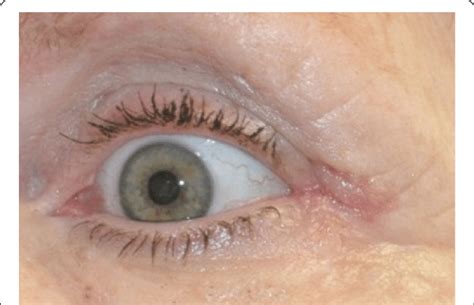 lateral canthus post operative day   scientific diagram