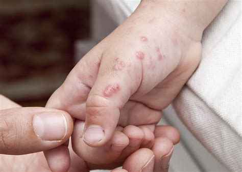 shingles  treatments dermatology