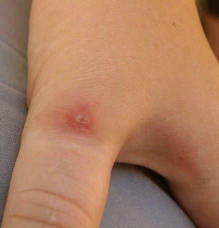 Pictures, Symptoms, and Treatment of Black Widow Spider Bites - HubPages