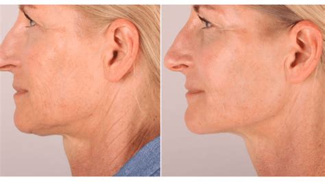 radiesse neck     photo examples medical spa rx