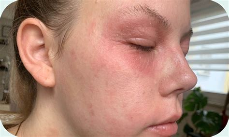 Erfahrungen SIRIDERMA Alina | SIRIDERMA