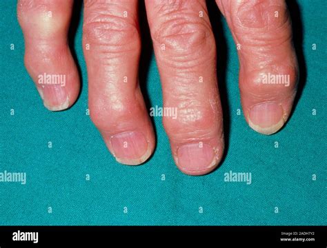 Heberden's node on fingers. A hand affected by osteoarthritis showing ...