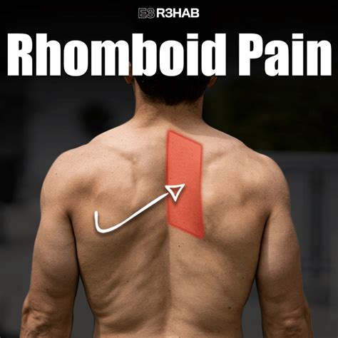 Rhomboid Pain - E3 Rehab 