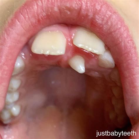 conical mesioden justbabyteeth