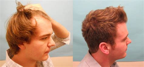 hair plugs  men celebrities  hair transplant elon musk