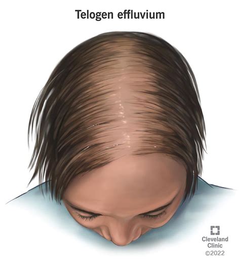 telogen effluvium symptoms  treatment regrowth