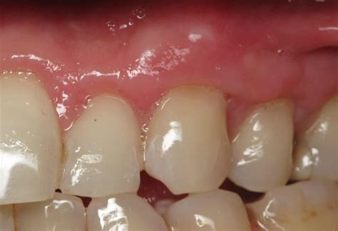Bottom Of Teeth Showing Through Gums at Patty Jackson blog
