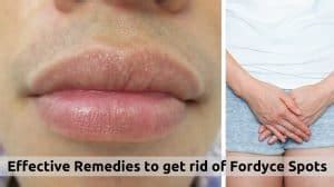 Effective Remedies to get rid of Fordyce Spots
