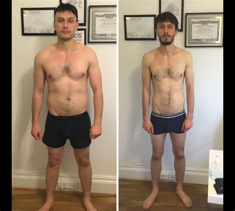 Foto: Antes e depois de Richard Gadd, protagonista de 'Bebê Rena