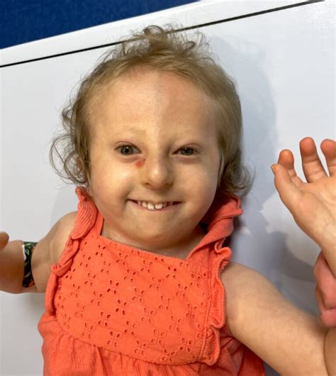 thriving   odds children  trisomy  edwards syndrome