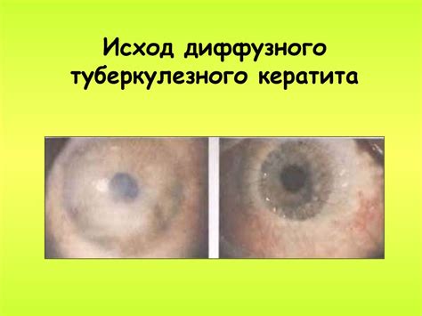Синдром красного глаза - презентация онлайн