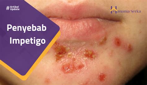 penyebab impetigo hanania serka