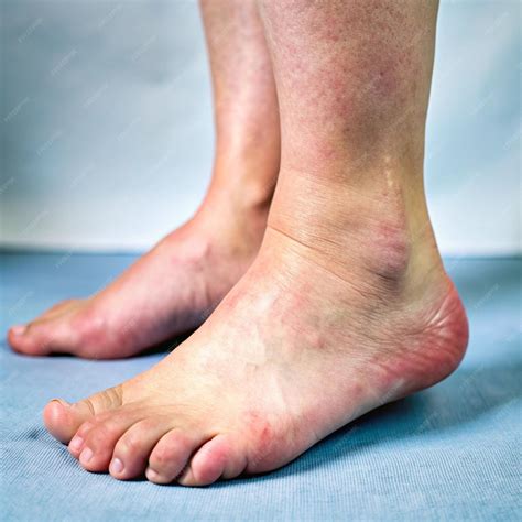 Educational Images of Swollen Ankles in Women Understanding Common