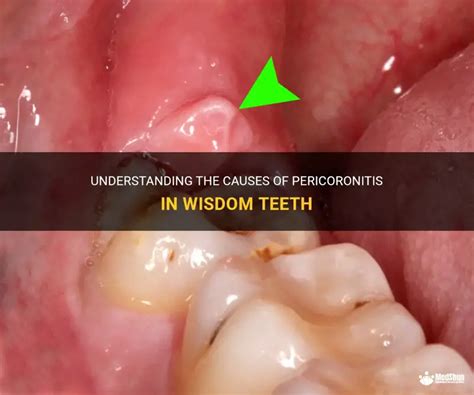 understanding    pericoronitis  wisdom teeth medshun