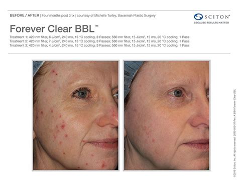 Forever Clear - BBL - Acne Treatment - Well Medical Arts: Seattle's ...