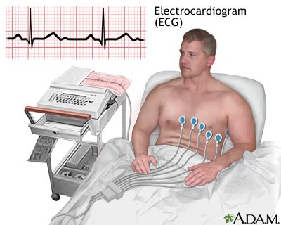 ecg medlineplus medical encyclopedia image