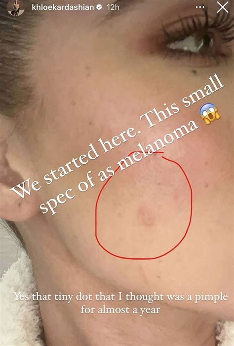 Khloe Kardashian reveals she had a melanoma tumour in her cheek