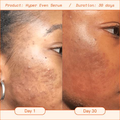 results spl hyper skin