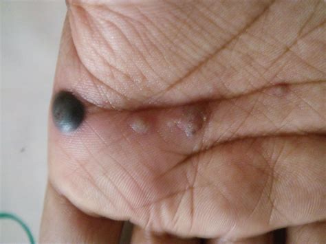 First Time Went For Cryotherapy. Is This Normal? : r/Warts