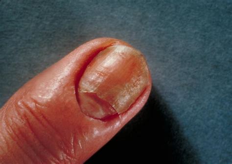 biol  lab manual candida albicans infection   nails