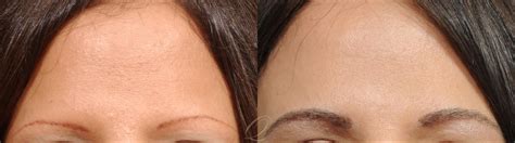 eyebrow hair transplant   photo gallery serving