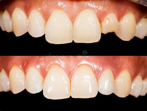 Dentinho Antes E Depois - Dentes Antes E Depois Do Tratamento Imagem de Stock - Imagem de ...