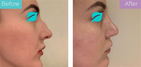 nose thread lift procedure safety cost longevita