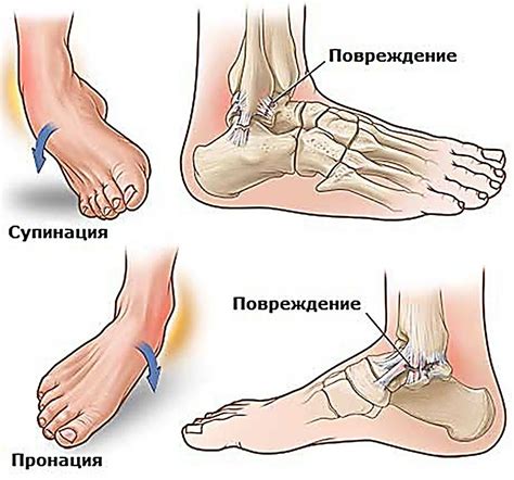 Перелом наружной и внутренней лодыжки со смещением и без: симптомы и ...